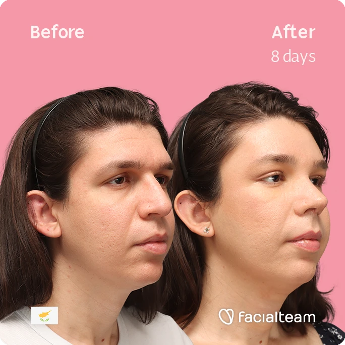 Angeled square image of FFS patient Rhea showing the results before-after with Facialteam consisting of forehead, rhinoplasty, and tracheal shave feminization surgery.