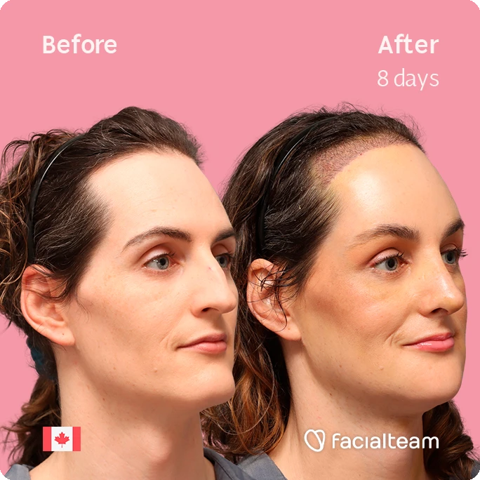 Angeled square image of FFS patient Jessica showing the results before-after with Facialteam consisting of forehead with SHT, rhinoplasty, chin, jaw, and tracheal shave feminization surgery.