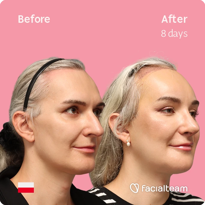 Algeled square image of FFS patient Ashley showing the results before-after with Facialteam consisting of forehead with SHT, rhinoplasty, chin and jaw feminization surgery.