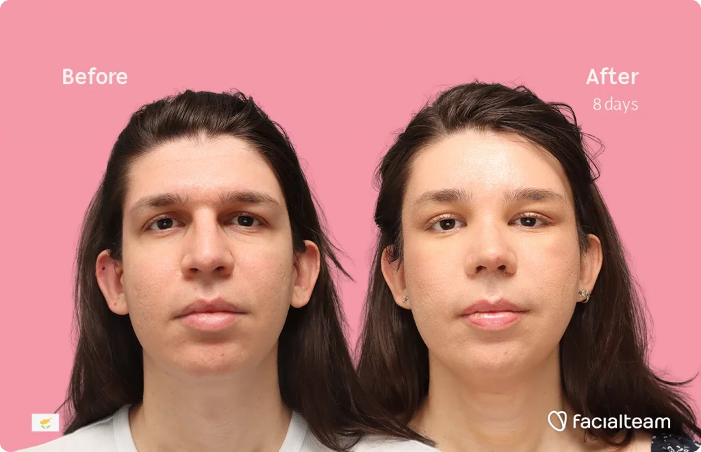 Frontal image of FFS patient Rhea showing the results before-after with Facialteam consisting of forehead, rhinoplasty, and tracheal shave feminization surgery.