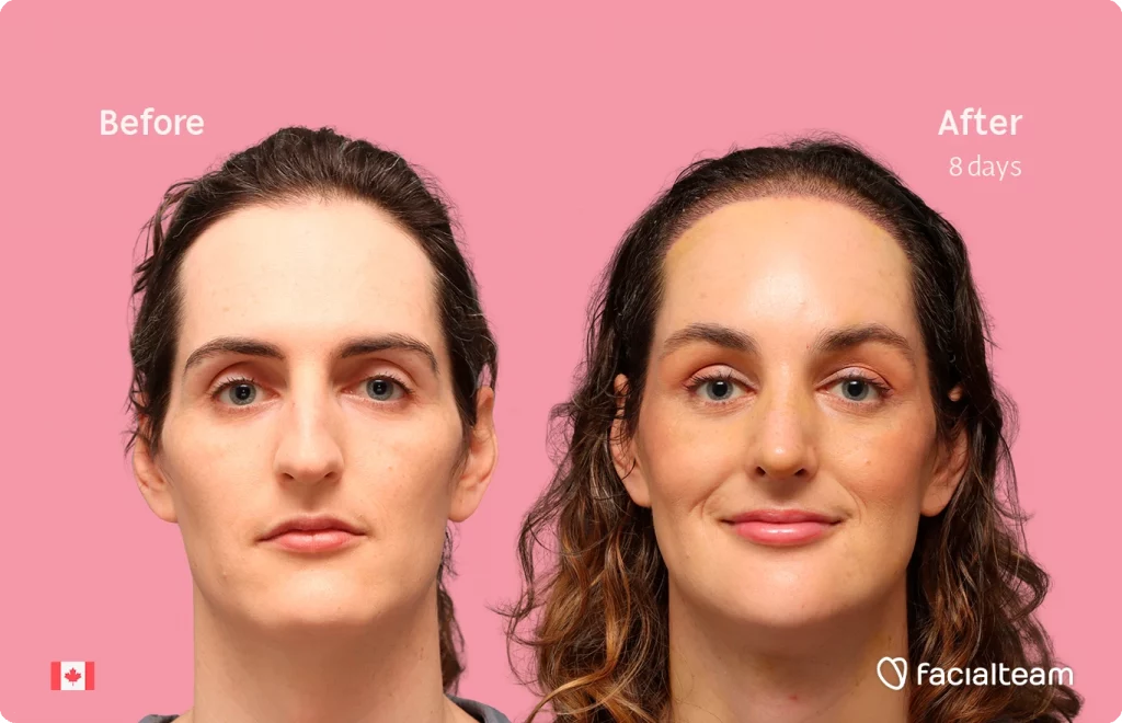 Frontal image of FFS patient Jessica showing the results before-after with Facialteam consisting of forehead with SHT, rhinoplasty, chin, jaw, and tracheal shave feminization surgery.