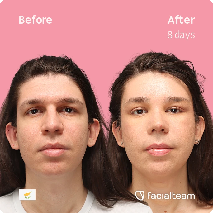 frontal square image of FFS patient Rhea showing the results before-after with Facialteam consisting of forehead, rhinoplasty, and tracheal shave feminization surgery.