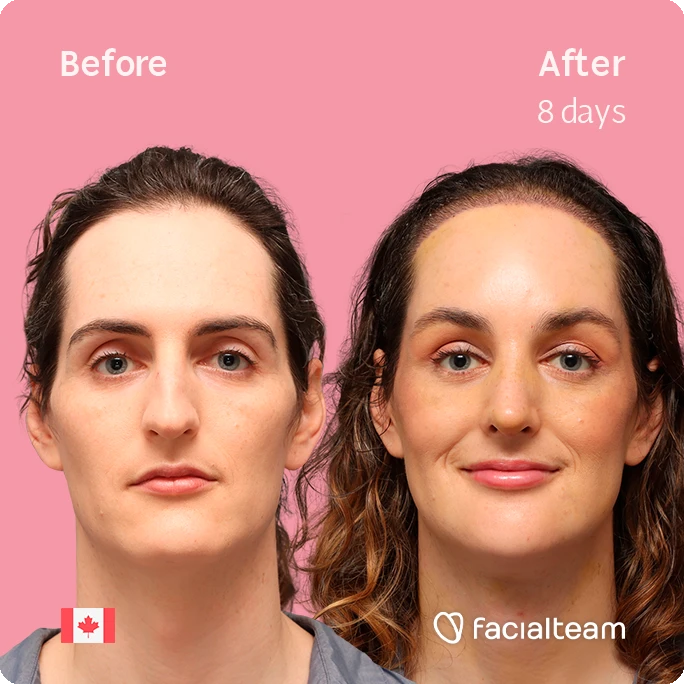 Frontal square image of FFS patient Jessica showing the results before-after with Facialteam consisting of forehead with SHT, rhinoplasty, chin, jaw, and tracheal shave feminization surgery.
