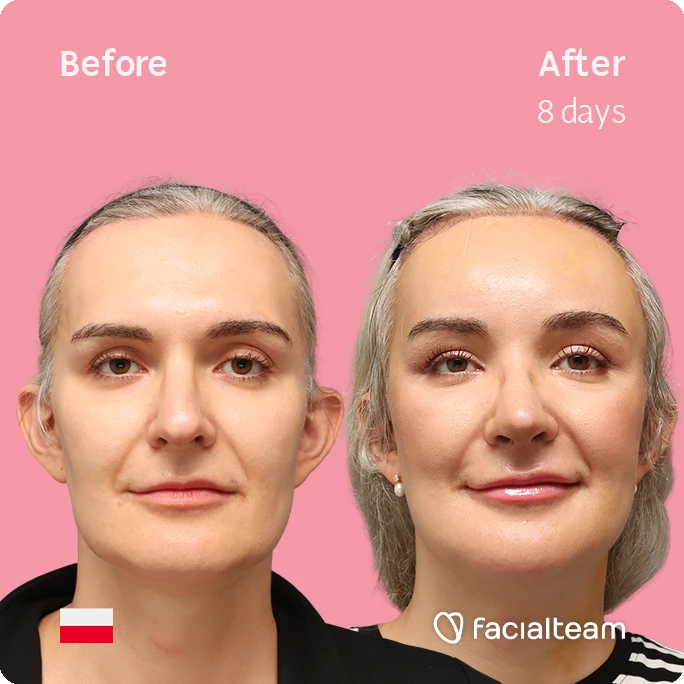 Frontal square image of FFS patient Ashley showing the results before-after with Facialteam consisting of forehead with SHT, rhinoplasty, chin and jaw feminization surgery.