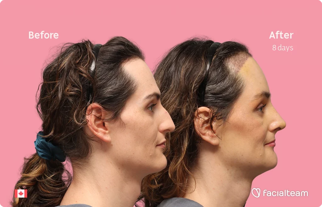 Side image of FFS patient Jessica showing the results before-after with Facialteam consisting of forehead with SHT, rhinoplasty, chin, jaw, and tracheal shave feminization surgery.