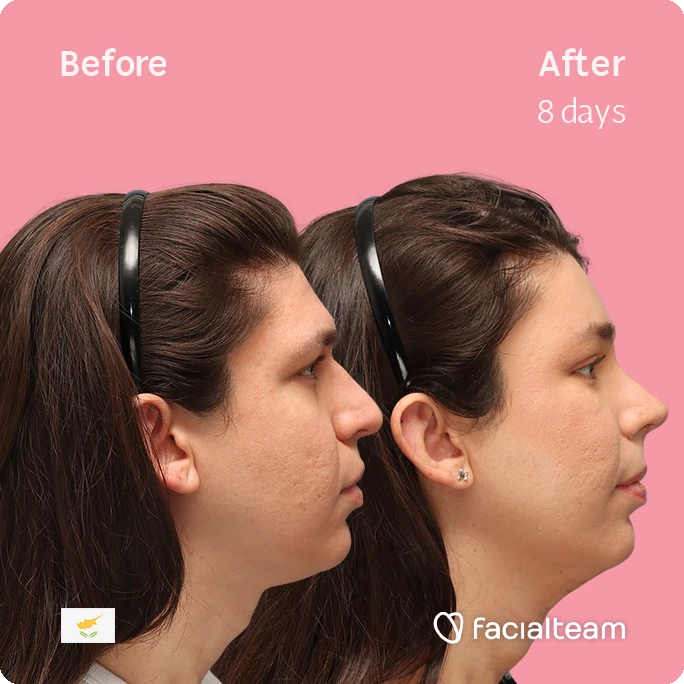 Side square image of FFS patient Rhea showing the results before-after with Facialteam consisting of forehead, rhinoplasty, and tracheal shave feminization surgery.