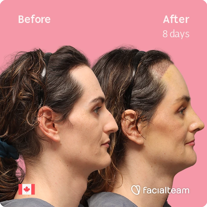 Side square image of FFS patient Jessica showing the results before-after with Facialteam consisting of forehead with SHT, rhinoplasty, chin, jaw, and tracheal shave feminization surgery.