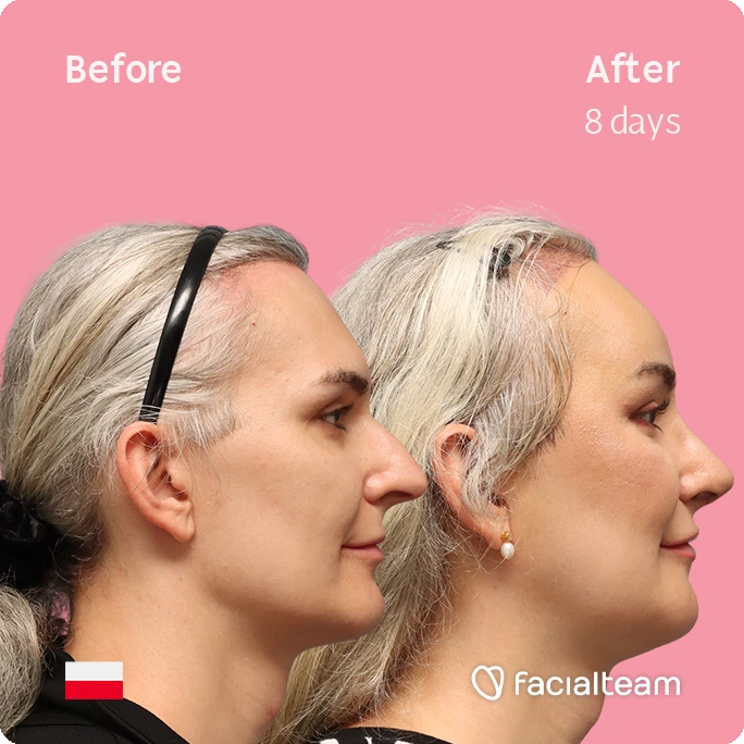 Side Square image of FFS patient Ashley showing the results before-after with Facialteam consisting of forehead with SHT, rhinoplasty, chin and jaw feminization surgery.
