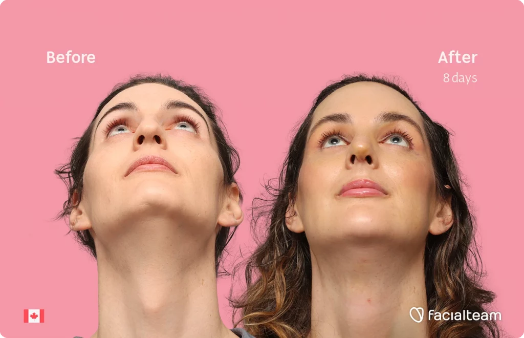 Frontal up image of FFS patient Jessica showing the results before-after with Facialteam consisting of forehead with SHT, rhinoplasty, chin, jaw, and tracheal shave feminization surgery.