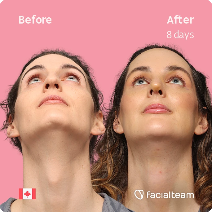 Frontal up square image of FFS patient Jessica showing the results before-after with Facialteam consisting of forehead with SHT, rhinoplasty, chin, jaw, and tracheal shave feminization surgery.