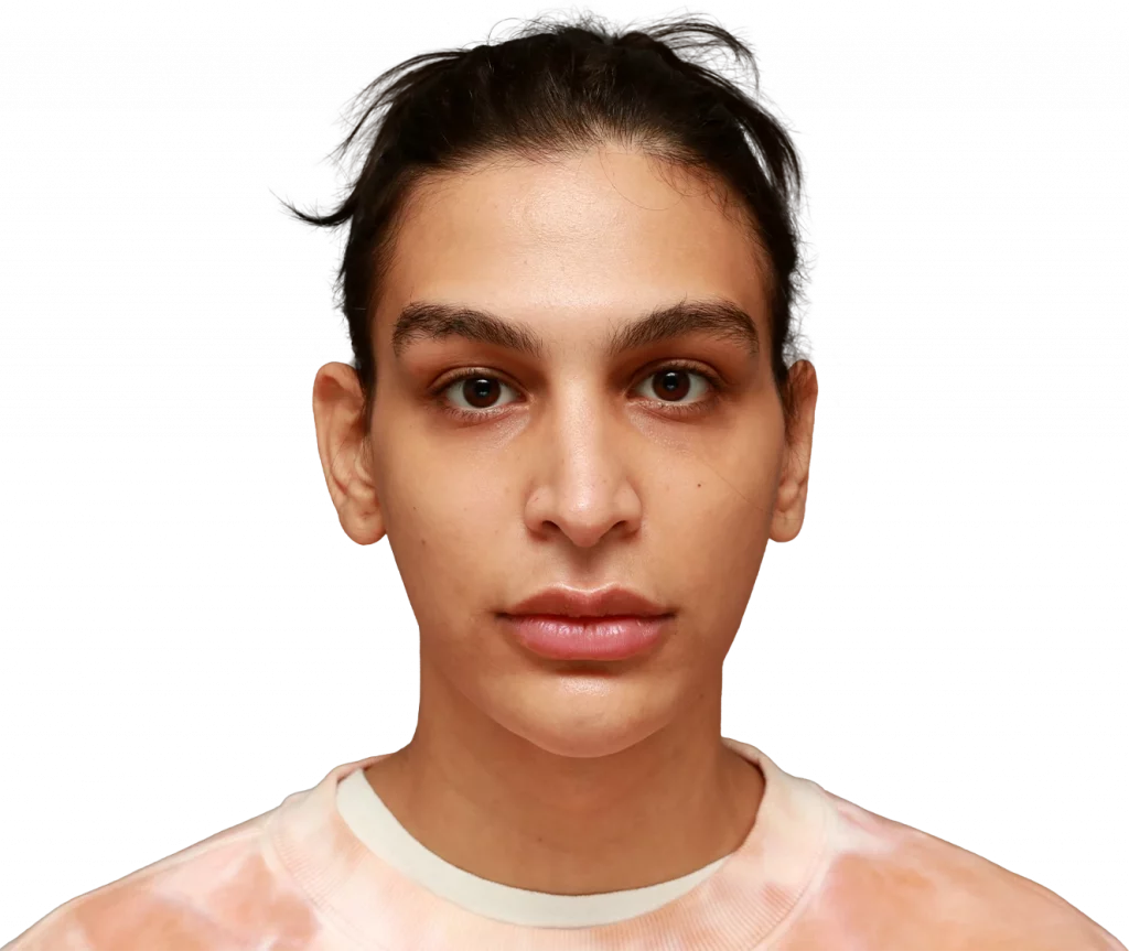Frontal picture taken from Collin before surgery.