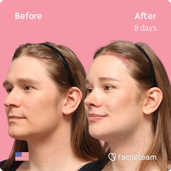 Angeled left square image of FFS patient Alice S. showing the results before-after with Facialteam consisting of forehead with SHT, rhinoplasty, chin, jaw, and tracheal shave feminization surgery.