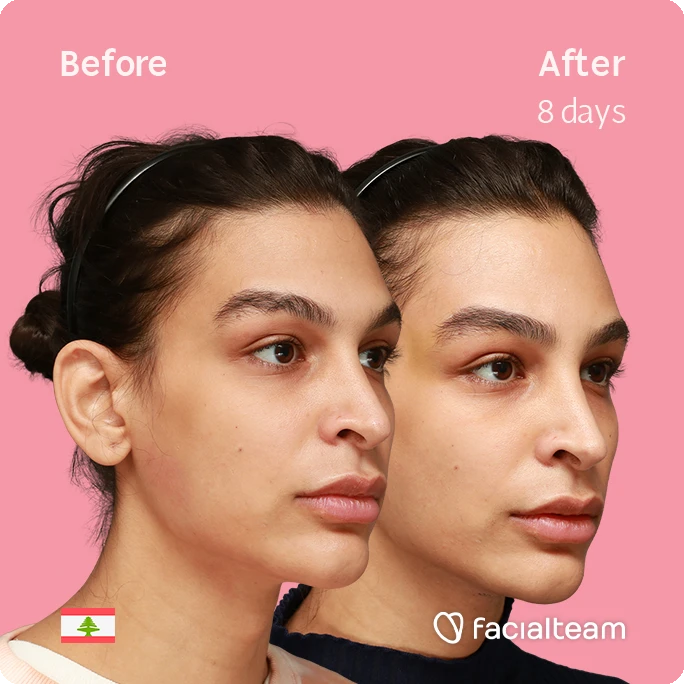 Angled riht square image of FFS patient Collin showing the results before-after with Facialteam consisting of forehead and tracheal shave.