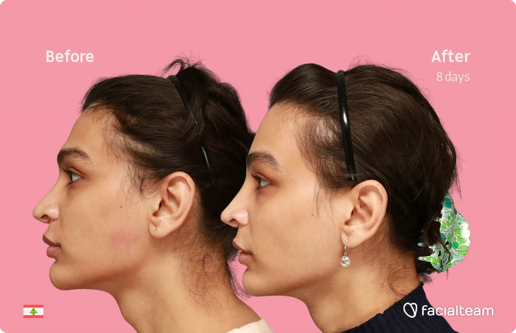 Side left image of FFS patient Collin showing the results before-after with Facialteam consisting of forehead and tracheal shave.