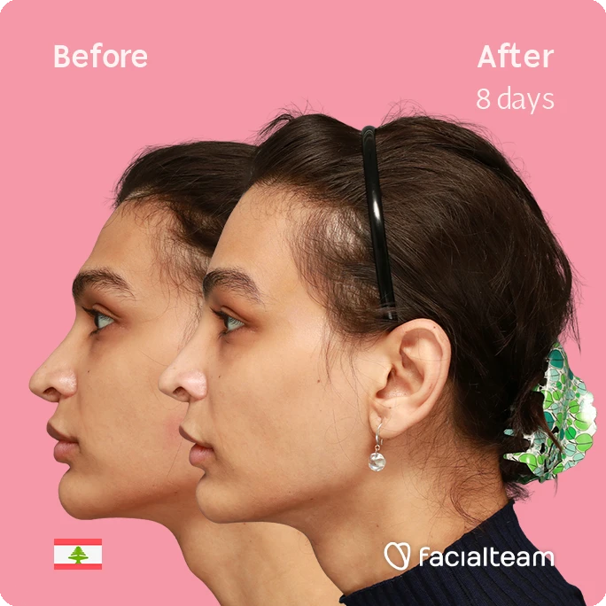Side left square image of FFS patient Collin showing the results before-after with Facialteam consisting of forehead and tracheal shave.