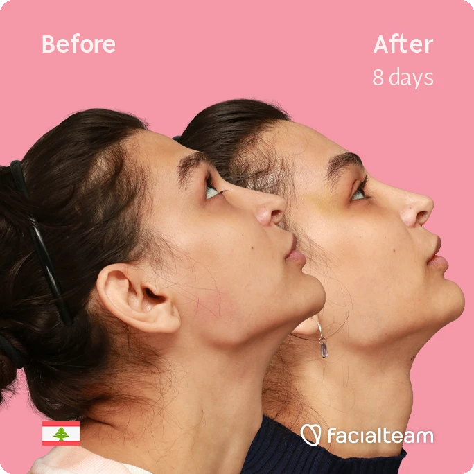 Side up right square image of FFS patient Collin showing the results before-after with Facialteam consisting of forehead and tracheal shave.
