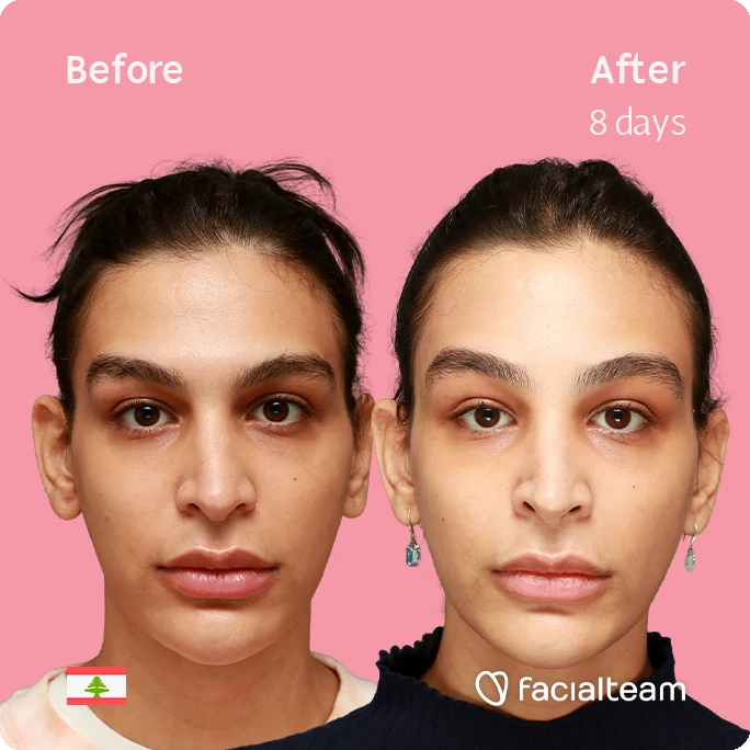 Frontal square image of FFS patient Collin showing the results before-after with Facialteam consisting of forehead and tracheal shave.