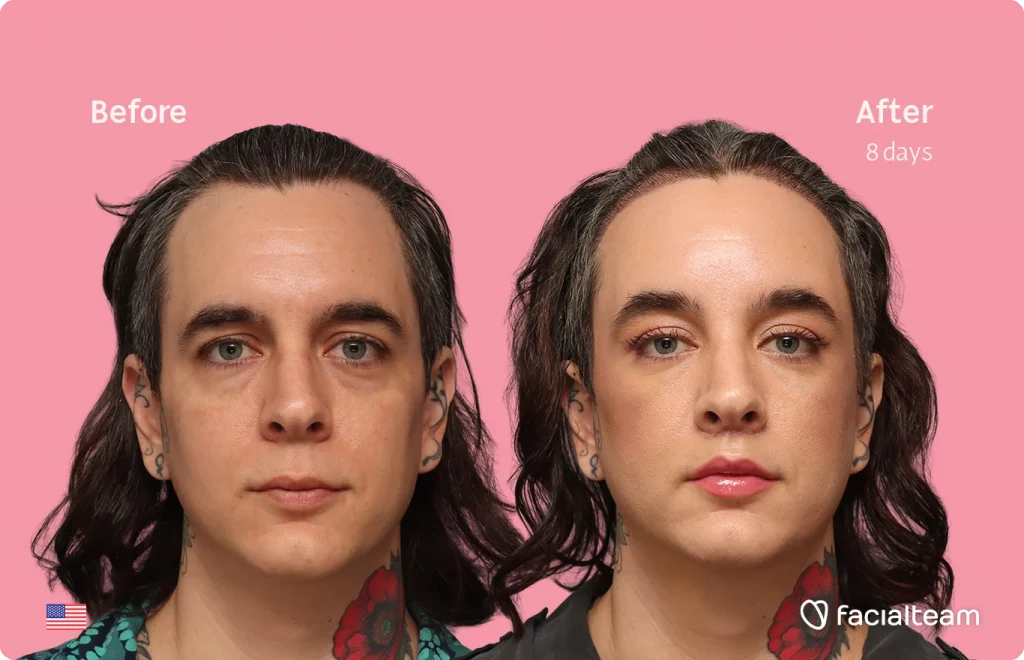 Frontal image of FFS patient Ceres showing the results before-after with Facialteam consisting of forehead with SHT and lip feminization surgery.