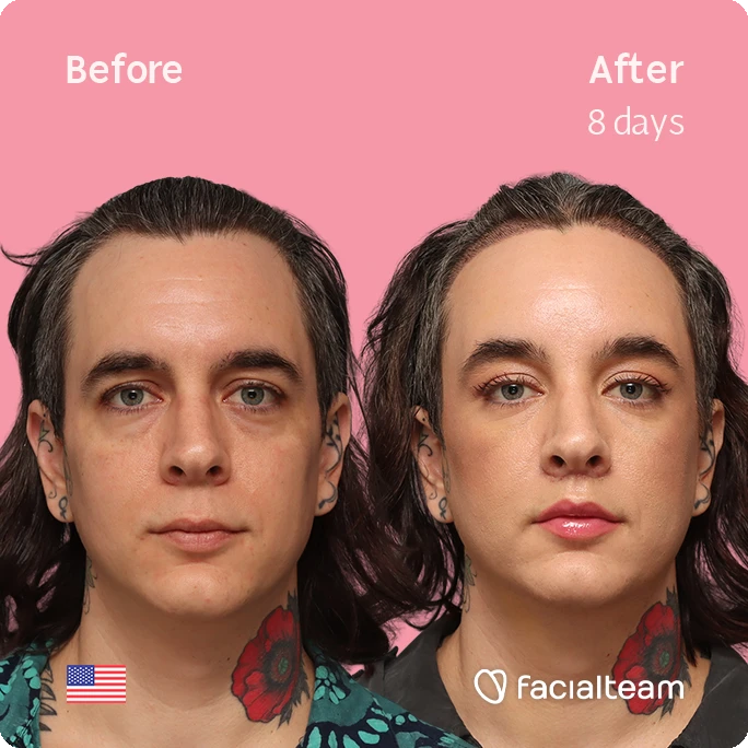 Frontal square image of FFS patient Ceres showing the results before-after with Facialteam consisting of forehead with SHT and lip feminization surgery.