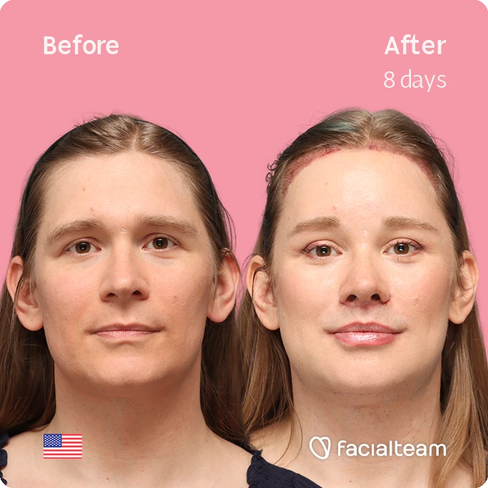 Frontal square image of FFS patient Alice S. showing the results before-after with Facialteam consisting of forehead with SHT, rhinoplasty, chin, jaw, and tracheal shave feminization surgery.