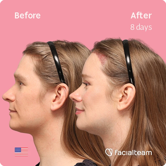 Side left square image of FFS patient Alice S. showing the results before-after with Facialteam consisting of forehead with SHT, rhinoplasty, chin, jaw, and tracheal shave feminization surgery.