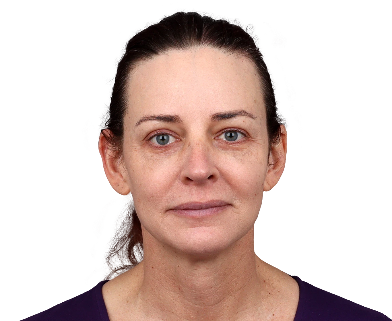 Allison J. Before and After FFS Surgery — FacialteamFacialteam