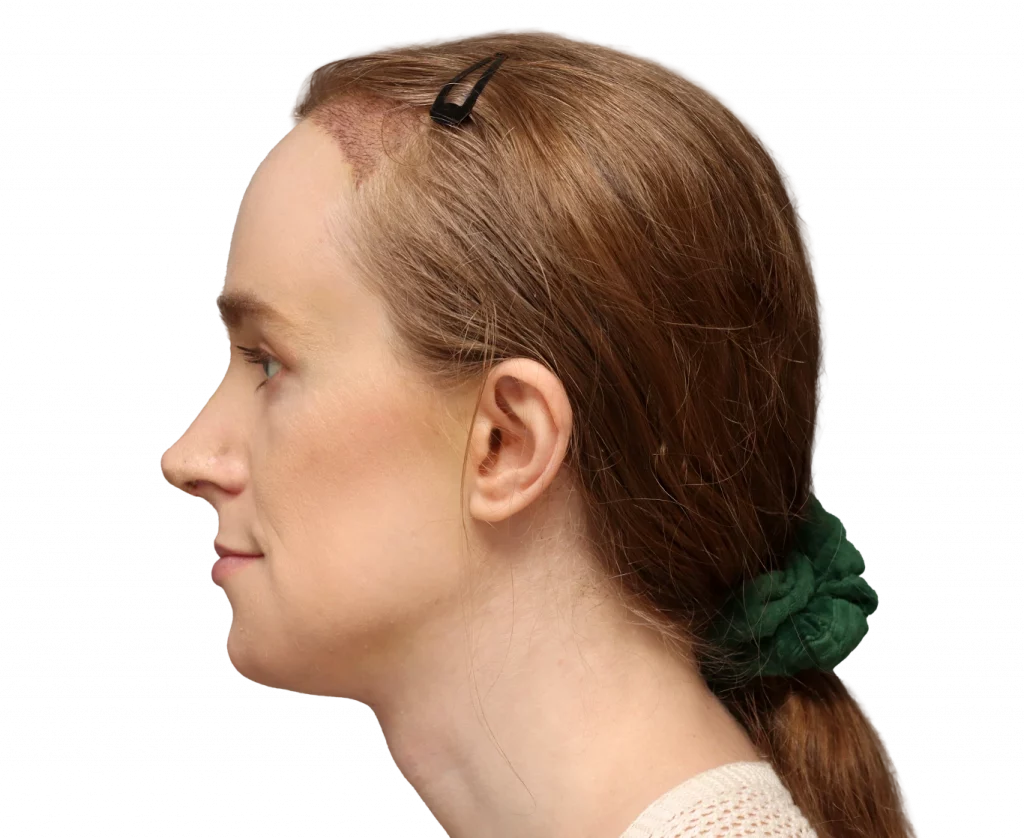 Side left profile photo of Joanna after surgery.