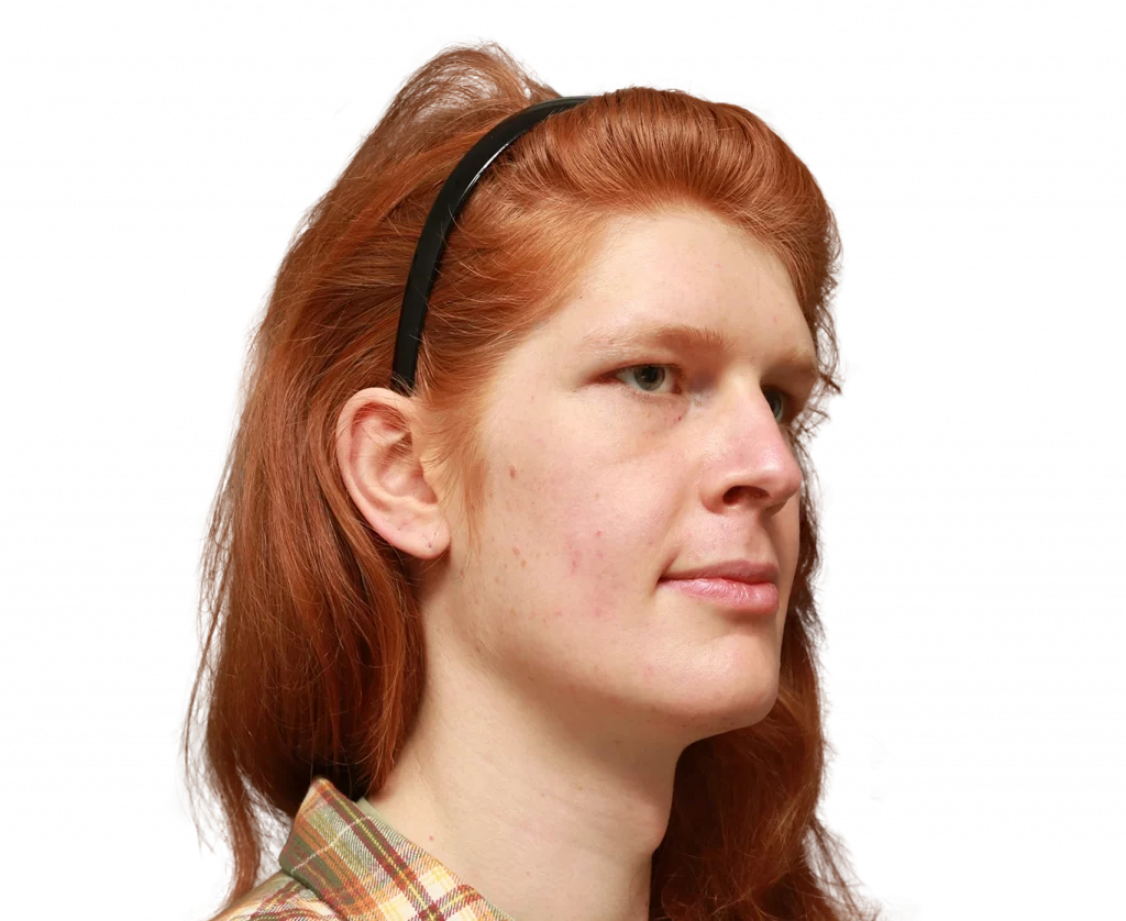 Right-angled profile photo of Luna L before surgery.