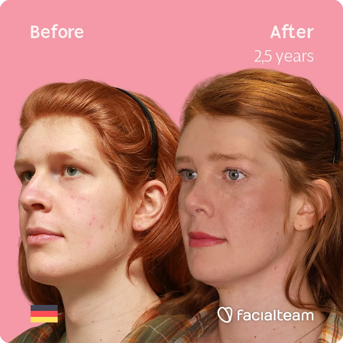 Angled left square image of FFS patient Luna showing the results before-after with Facialteam consisting of forehead, rhinoplasty, tracheal shave, chin and jaw feminization surgery.