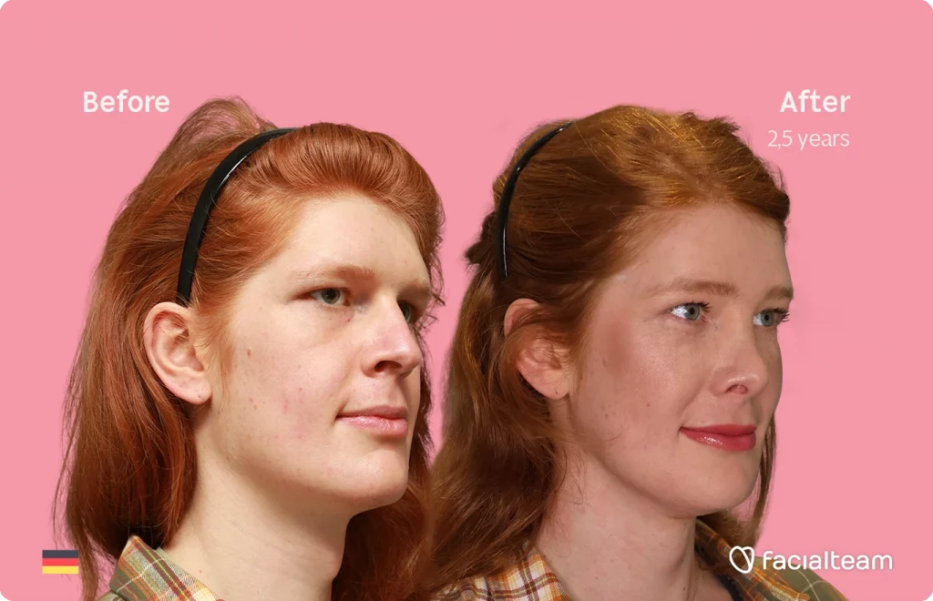 Angled right image of FFS patient Luna showing the results before-after with Facialteam consisting of forehead, rhinoplasty, tracheal shave, chin and jaw feminization surgery.