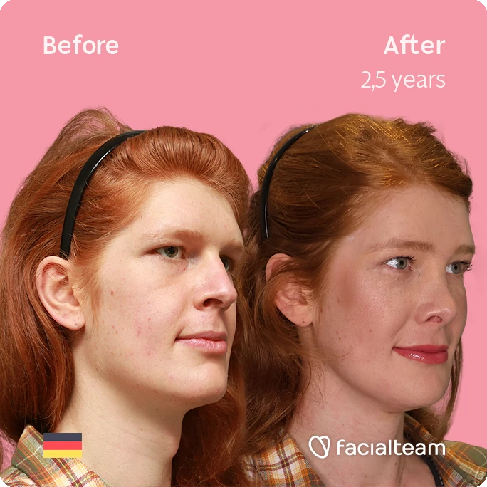 Angled right square image of FFS patient Luna showing the results before-after with Facialteam consisting of forehead, rhinoplasty, tracheal shave, chin and jaw feminization surgery.