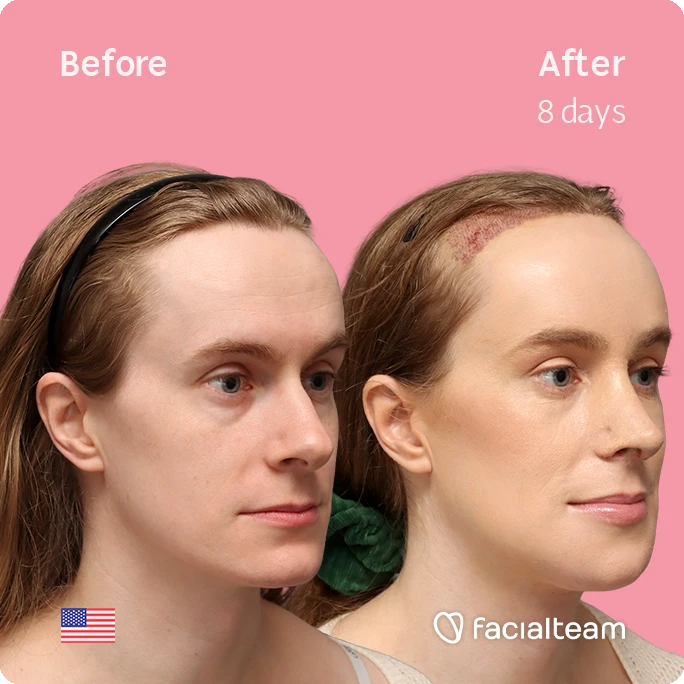 Angled right square image of FFS patient Joanna showing the results before-after with Facialteam consisting of forehead with SHT, rhinoplasty, tracheal shave and chin feminization surgery.
