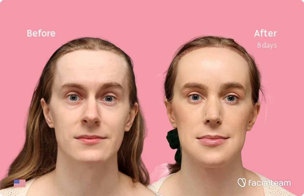 Frontal image of FFS patient Joanna showing the results before-after with Facialteam consisting of forehead with SHT, rhinoplasty, tracheal shave and chin feminization surgery.