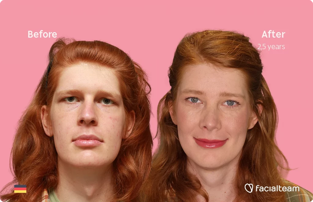 Frontal image of FFS patient Luna showing the results before-after with Facialteam consisting of forehead, rhinoplasty, tracheal shave, chin and jaw feminization surgery.