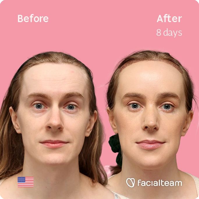 frontal square image of FFS patient Joanna showing the results before-after with Facialteam consisting of forehead with SHT, rhinoplasty, tracheal shave and chin feminization surgery.