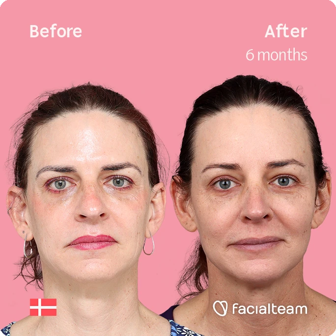 Frontal square image of FFS patient Allison showing the results before-after with Facialteam consisting of forehead and rhinoplasty feminization surgery.
