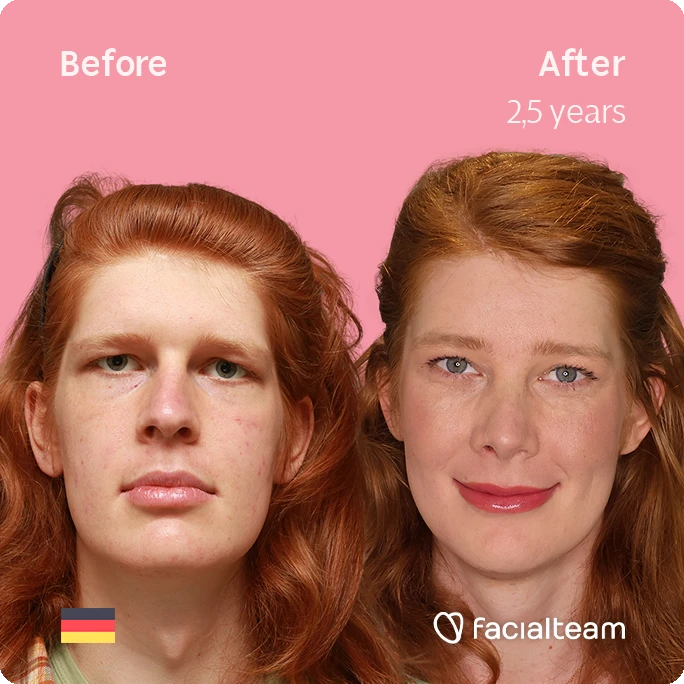 Frontal square image of FFS patient Luna showing the results before-after with Facialteam consisting of forehead, rhinoplasty, tracheal shave, chin and jaw feminization surgery.