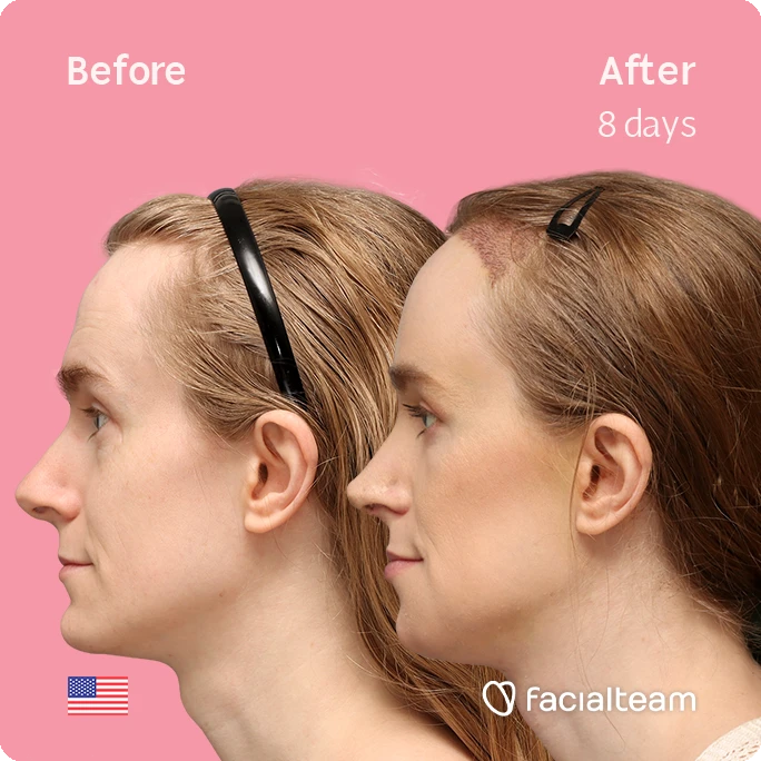 Side left square image of FFS patient Joanna showing the results before-after with Facialteam consisting of forehead with SHT, rhinoplasty, tracheal shave and chin feminization surgery.