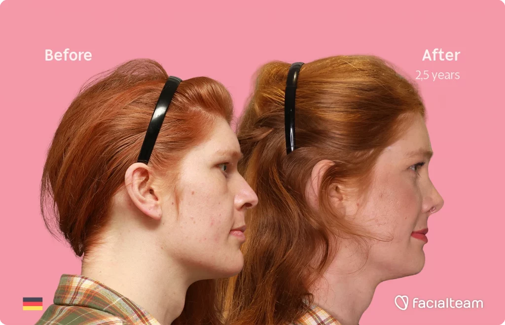 Side right image of FFS patient Luna showing the results before-after with Facialteam consisting of forehead, rhinoplasty, tracheal shave, chin and jaw feminization surgery.