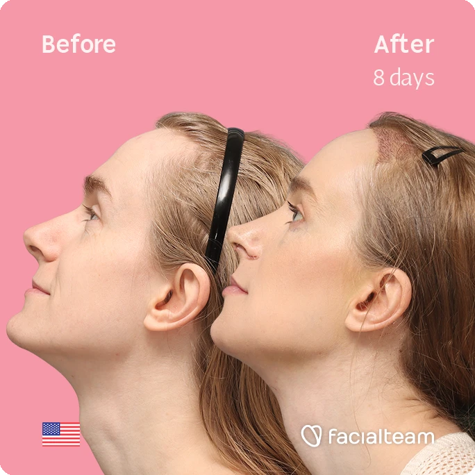 Side left up square image of FFS patient Joanna showing the results before-after with Facialteam consisting of forehead with SHT, rhinoplasty, tracheal shave and chin feminization surgery.