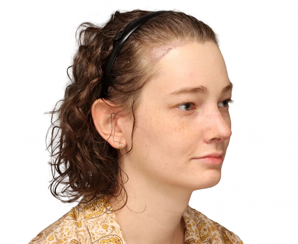 Angled right profile photo of Alina after surgery.
