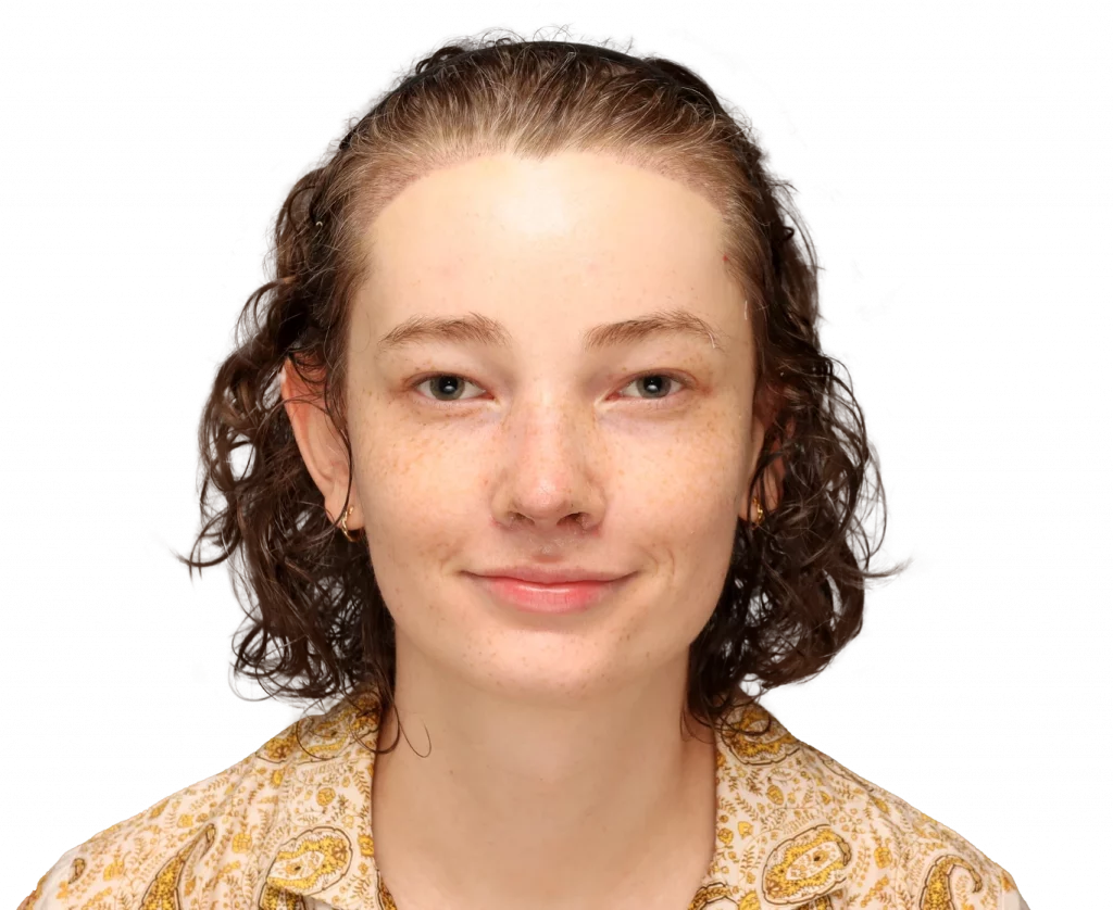 Frontal profile photo of Alina after surgery.