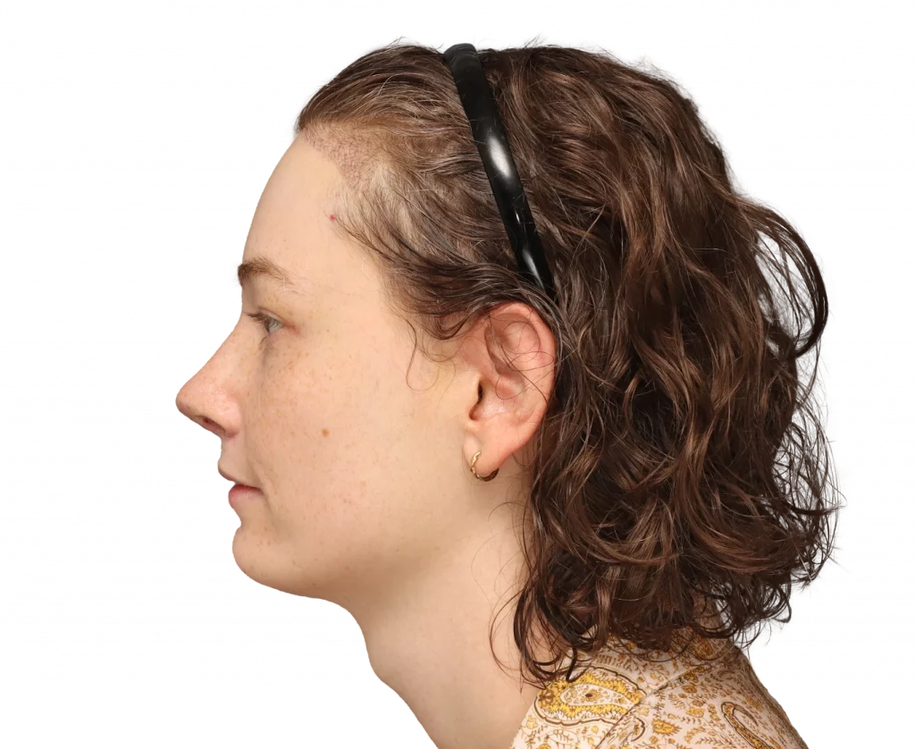 Side left profile photo of Alina after surgery.