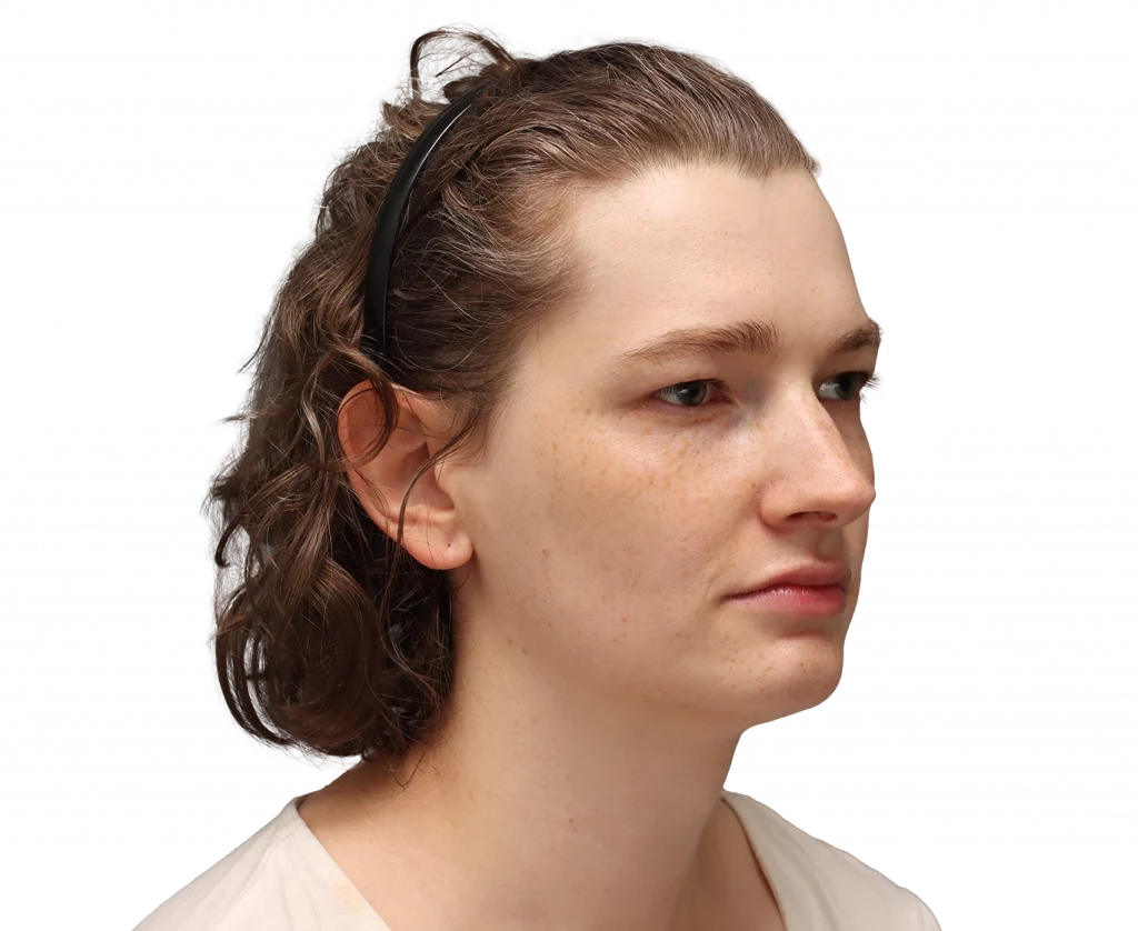 Angled right profile photo of Alina before surgery.