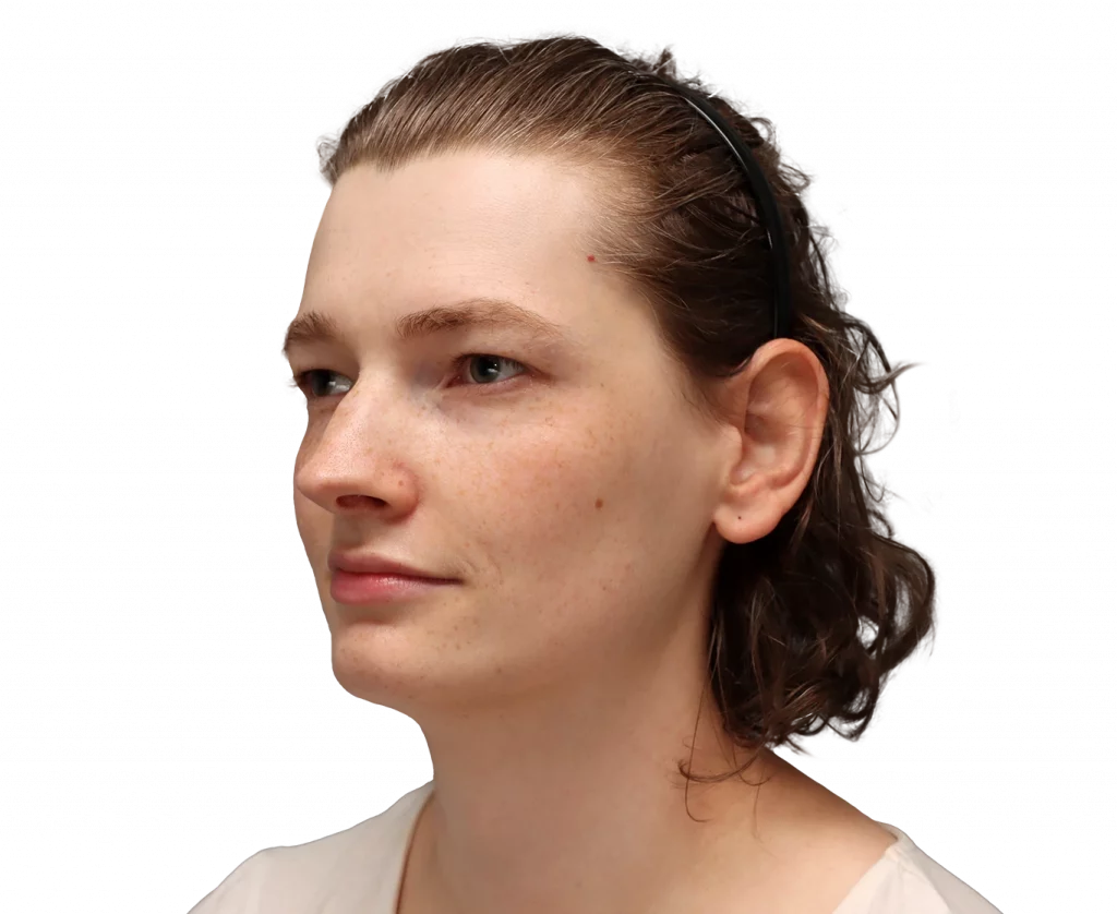 Angled left profile photo of Alina before surgery.