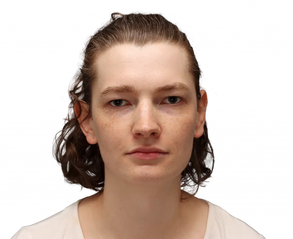 Frontal profile photo of Alina before surgery.