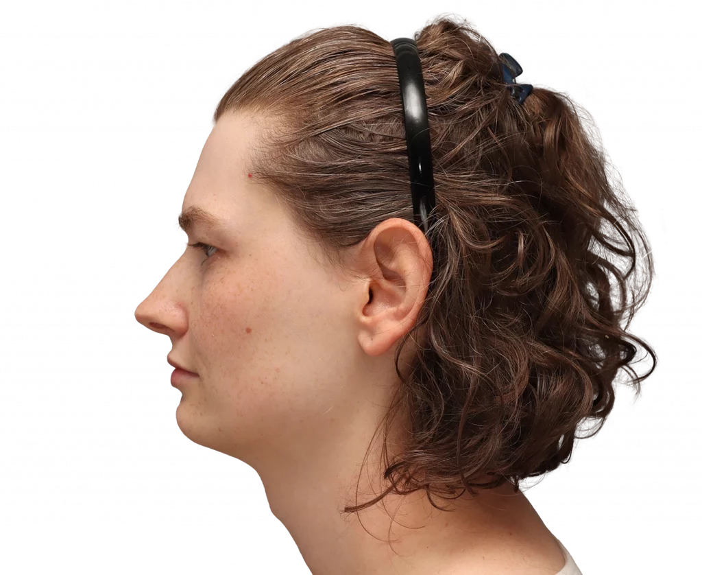 Side left profile photo of Alina before surgery.