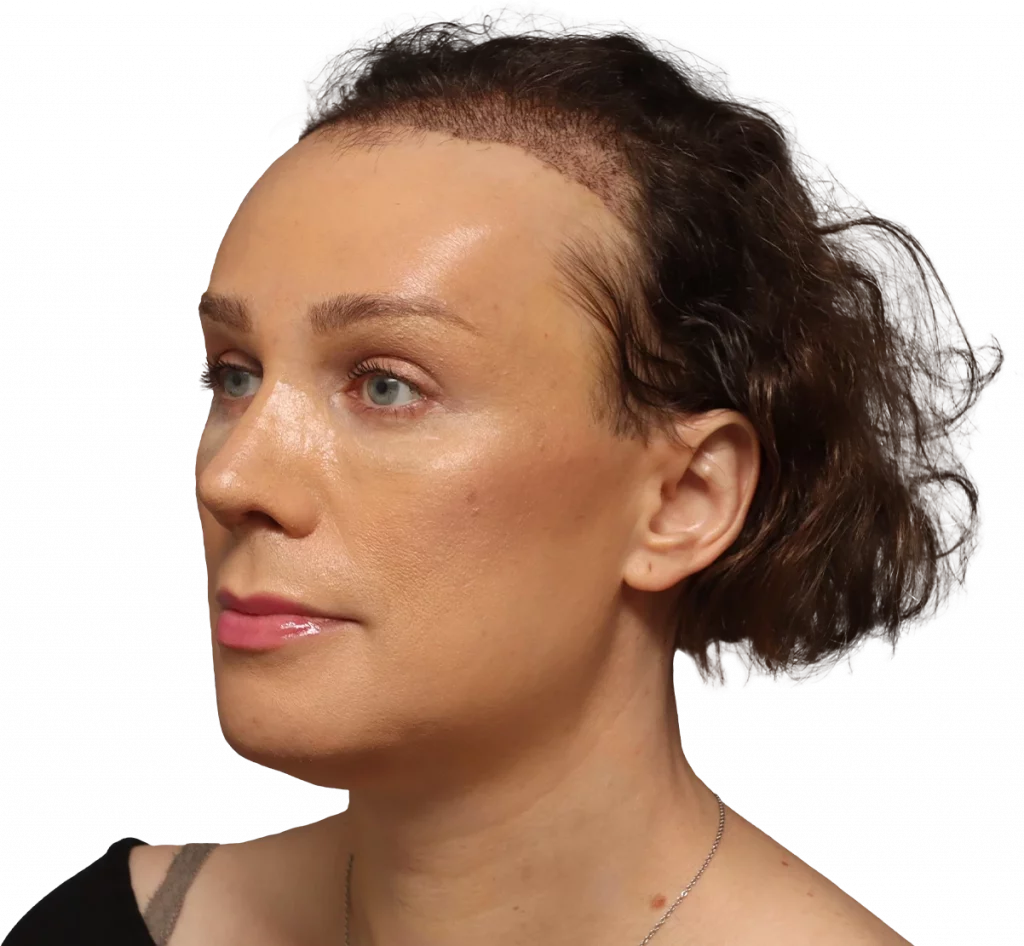 Angled left profile photo of Lucia after surgery.