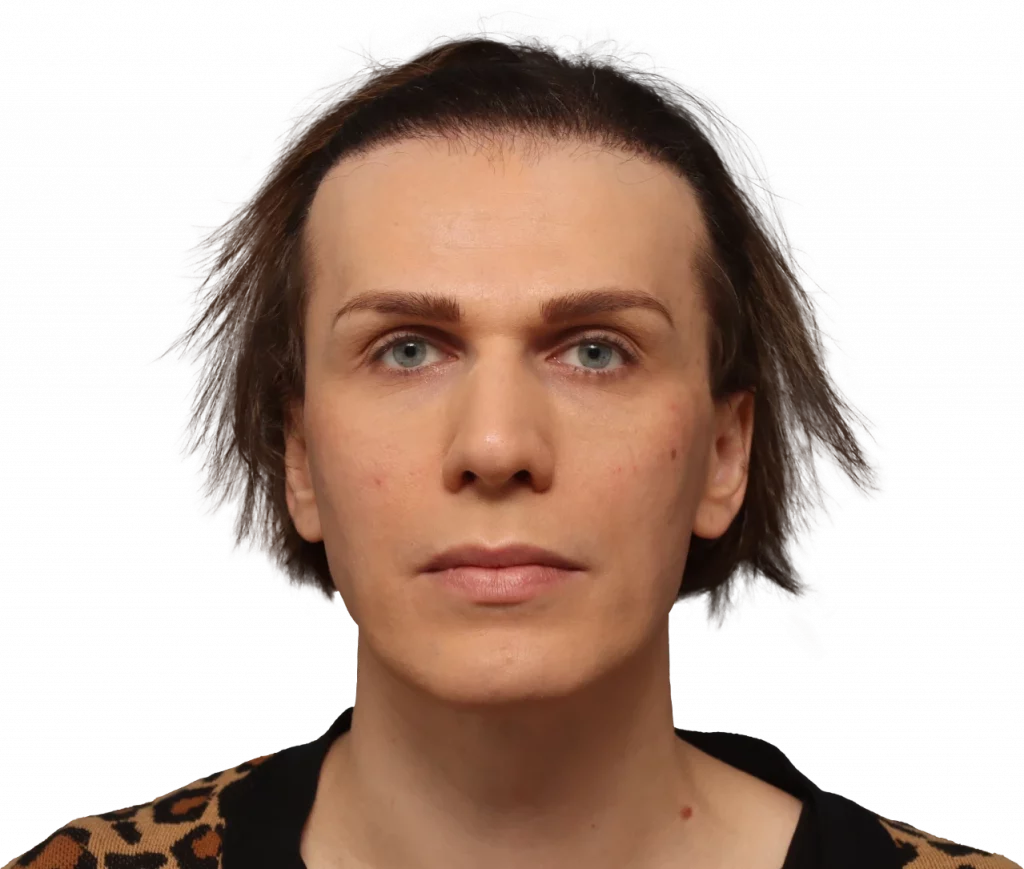 Frontal profile photo of Lucia before surgery.