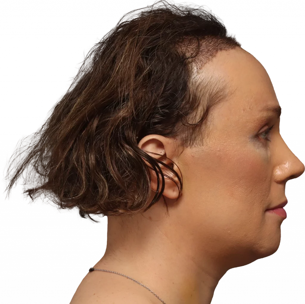 Side right profile photo of Lucia after surgery.